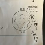 血栓性外痔核の手術を受けました。術後の経過から完治までの期間。