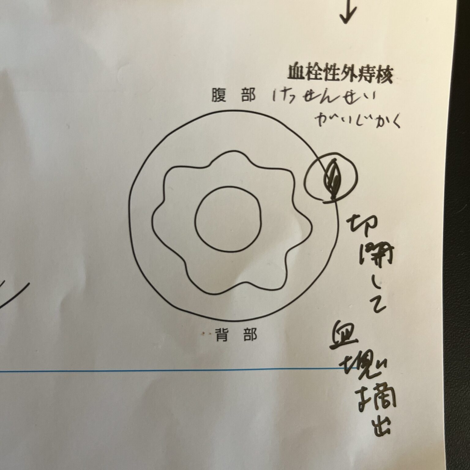 【体験談】血栓性外痔核の手術を受けました。術後の経過から完治までの期間。 - norinocafe blog