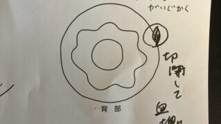 血栓性外痔核の手術を受けました。術後の経過から完治までの期間。
